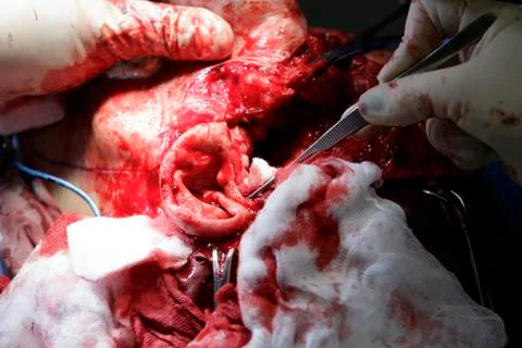 Facial surgery Foto stock