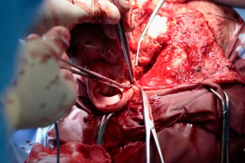 Facial surgery 写真素材