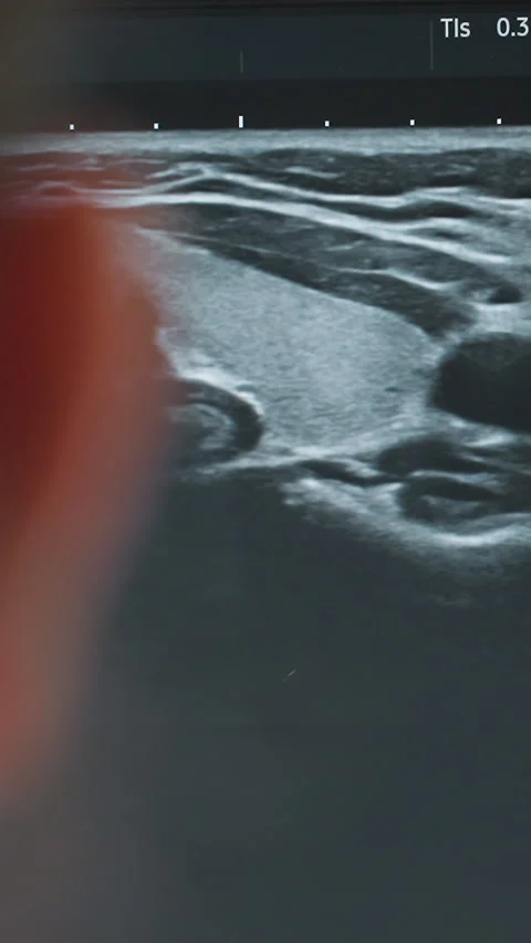 Faint nodule seen on sonogram, Scan shows low echo rounded lesion pattern Video stock 323627856