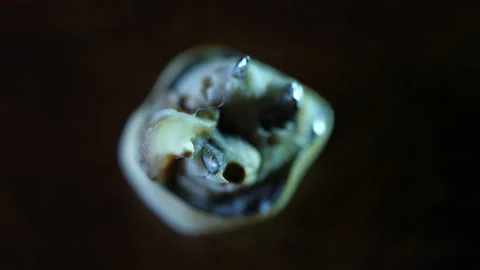 False Teeth extracted. Pulled out with real broken off tooth attached to metal. Stockbeeldmateriaal 137337990