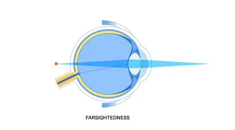 Farsightedness eye disease Stock Illustration