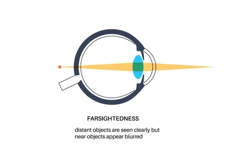 Farsightedness eye disease Stock Illustration