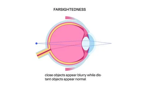Farsightedness eye disease Stock Illustration