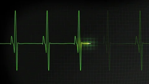 Fast heartbeat pulse monitored on hospital EKG display loop Stock Footage