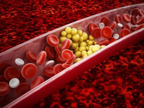 Fat cells blocking the blood flow inside human vein. 3D illustration Stock Illustration