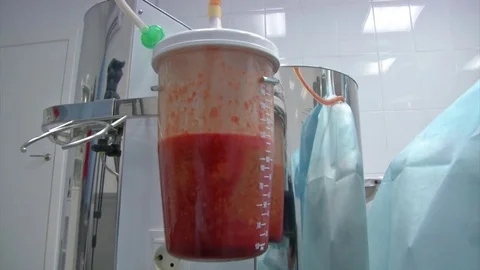 Fat liquid in the bottle from liposuction Stock Footage 83149987