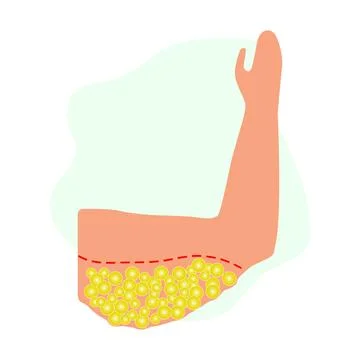 Fat overweight arm liposuction vector design Stock Illustration