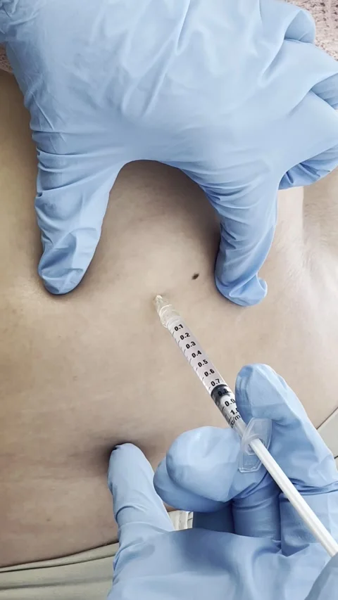 Fat Reduction Injection 4K Close-Up Aesthetic Clinic Treatment with Needle Stock Footage 311091026