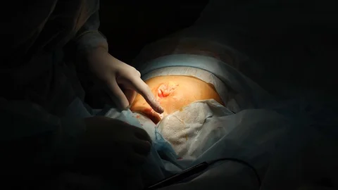 Fat removal operation Stockbeeldmateriaal 122903813