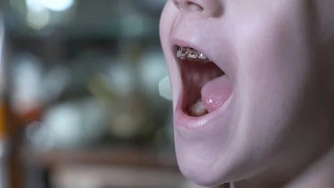 Father trying to pull out son's wobbly decayed tooth. dad pulling tooth. Caries Stock Footage 119282214