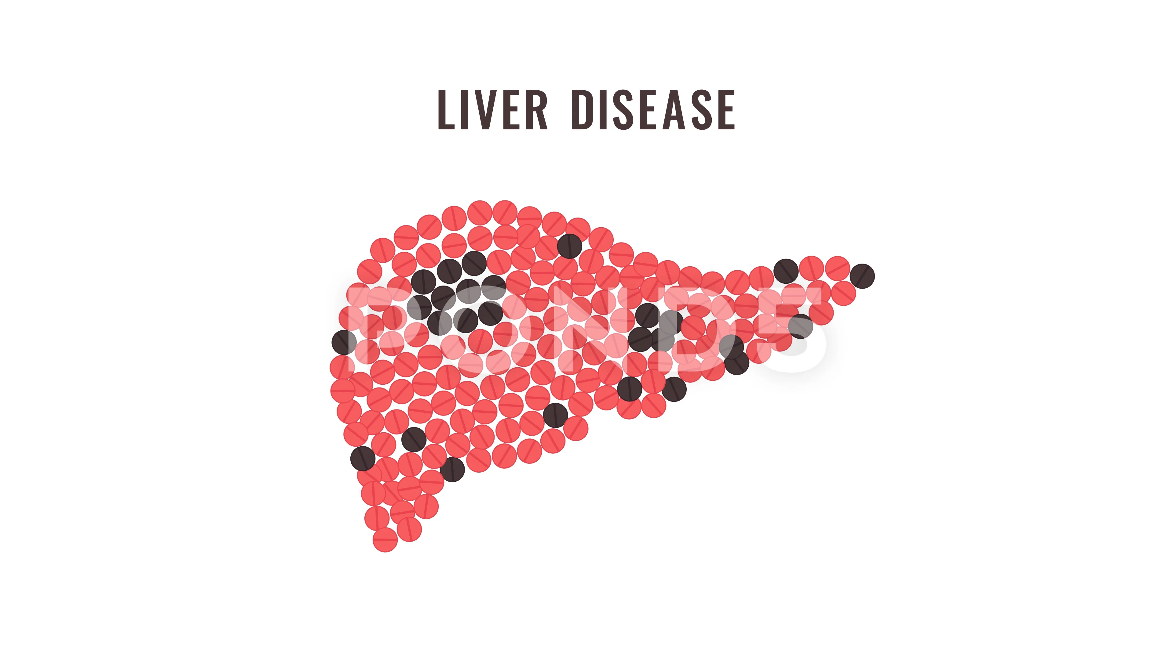Fatty liver pills awareness animation | Stock Video | Pond5