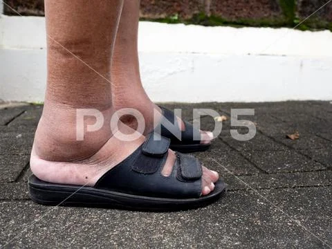 The feet of man with diabetes, dull and swollen. Due to the toxicity of diabe Stock Photos