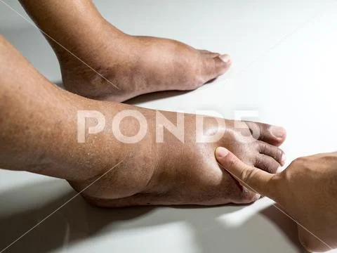 The feet of people with diabetes, dull and swollen. Due to the toxicity of di Stock Photos