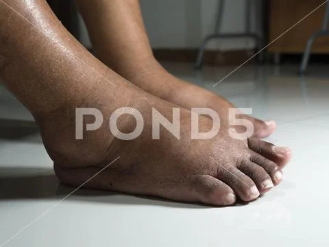 The feet of people with diabetes, dull and swollen. Due to the toxicity of di Stock Photos