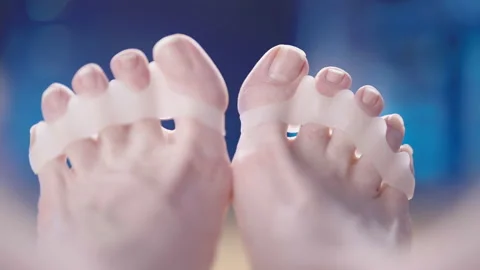 Feet with soft silicone toe corrector fixing hallux valgus close-up 4K Stock Footage 170118117