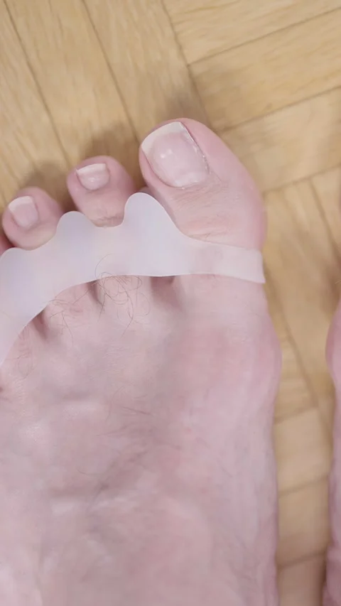 Feet with soft silicone toe corrector fixing hallux valgus person POV Video stock 324961005