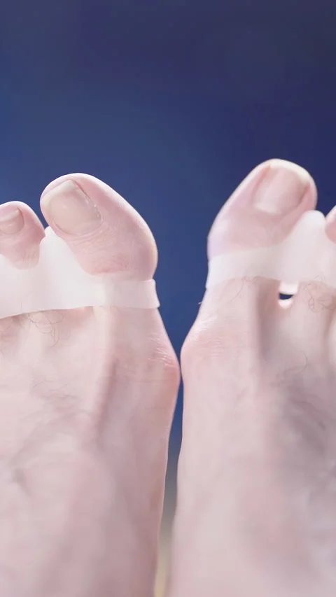 Feet with soft silicone toe corrector fixing hallux valgus close-up Video stock 324961008