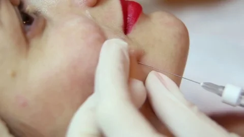 Female face during the procedure Botox injection Stock Footage 83547235