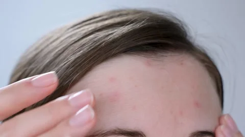 Female forehead with red pimples and inflammation on gray background close-up. Stock Footage 255685282