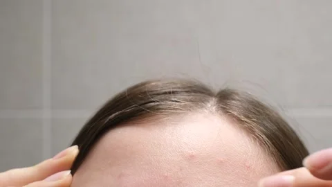 Female forehead with red pimples and inflammation close-up against a background Stock Footage 330219618