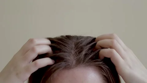 Female hands scratching the top of the head, oily hair dandruff on the head Video stock 278348769