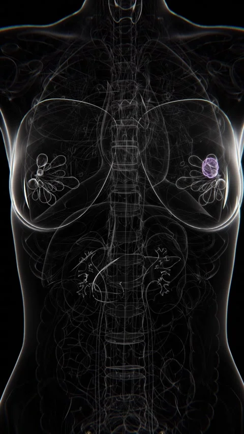 Female Left Side Chest X-ray Vertical Video | Cancer Indication Left side Stock Footage 301071874