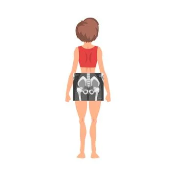 Female Thigh Bone Back View Roentgen Vector Illustration. Radiographic Procedure Stock Illustration