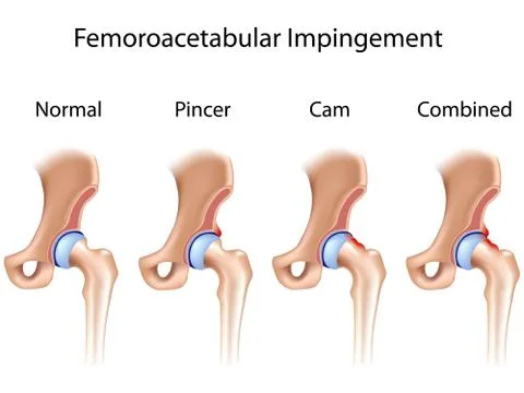 Femoroacetabular impingement イラスト素材