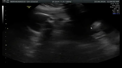 Fetus Foetus Ultasound scan through uterus 24fps Stock Footage
