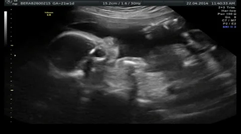 Fetus Foetus Ultasound Upper Torso and Head 24fps Stock Footage 37428372