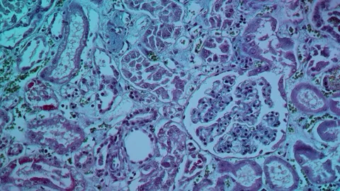 Fibrin deposits in the kidney, microscopy 스톡 동영상 343129136