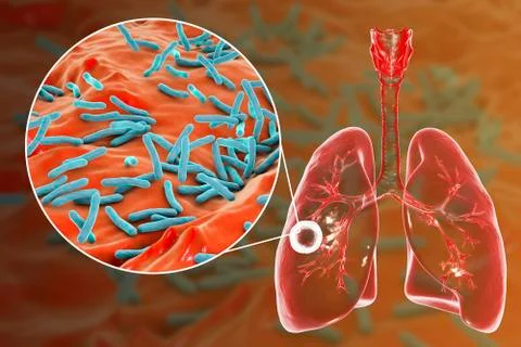 Fibrous-cavernous pulmonary tuberculosis Stock Illustration