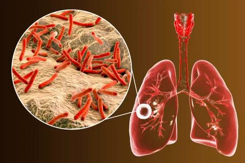 Fibrous-cavernous pulmonary tuberculosis Stock Illustration