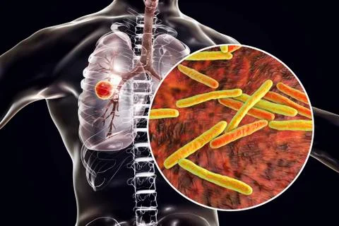 Fibrous-cavernous pulmonary tuberculosis Stock Illustration