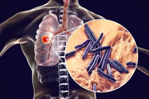 Fibrous-cavernous pulmonary tuberculosis Stock Illustration