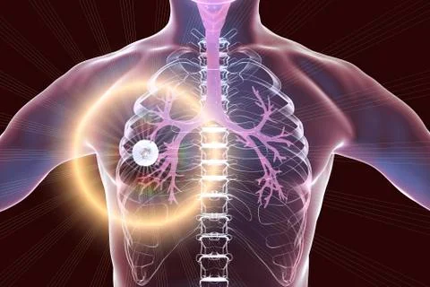 Fibrous-cavernous pulmonary tuberculosis Stock Illustration