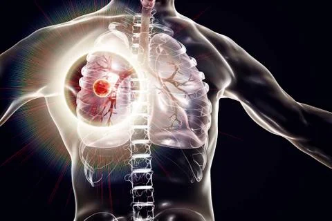 Fibrous-cavernous pulmonary tuberculosis Stock Illustration