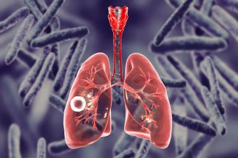 Fibrous-cavernous pulmonary tuberculosis Stock Illustration