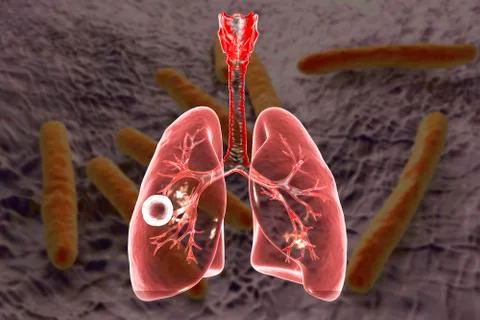 Fibrous-cavernous pulmonary tuberculosis Stock Illustration