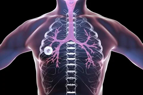 Fibrous-cavernous pulmonary tuberculosis Stock Illustration