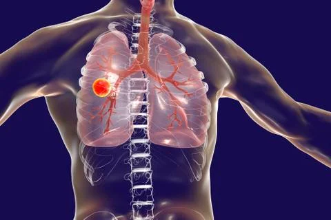 Fibrous-cavernous pulmonary tuberculosis Stock Illustration