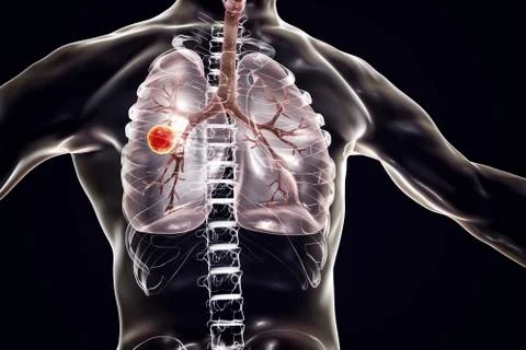 Fibrous-cavernous pulmonary tuberculosis Stock Illustration