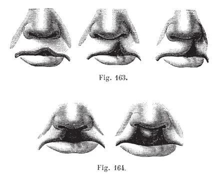 Fig. 163. Degrees of cleft lip simple,  Fig. 164. Cleft lip double, vintage e Stock Illustration