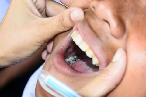 Fill teeth Stock Photos