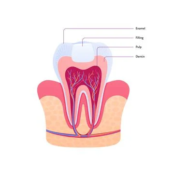 Filled tooth chart. Cross section. Teeth with filling Stock Illustration