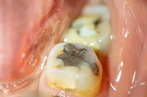 Filling in back tooth closeup macro view Foto stock