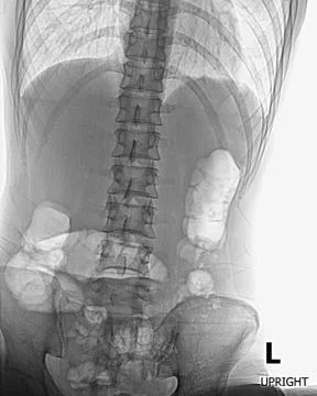 Film X-ray Abdomen: Acute appendicitis Stock Photos