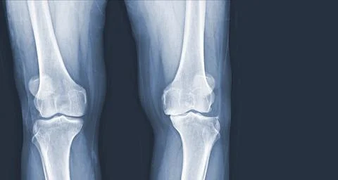 Film x-ray of human knee Osteoarthritis of the Knee normal ligaments Medica.. Stock Photos