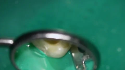 Final inspection of molar root. Thorough examination of prepared root canal in Stock Footage 343950391
