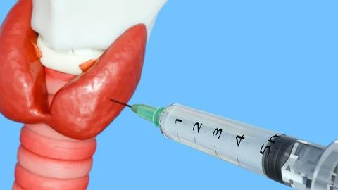 A fine needle aspiration biopsy of the thyroid gland. Stock Illustration